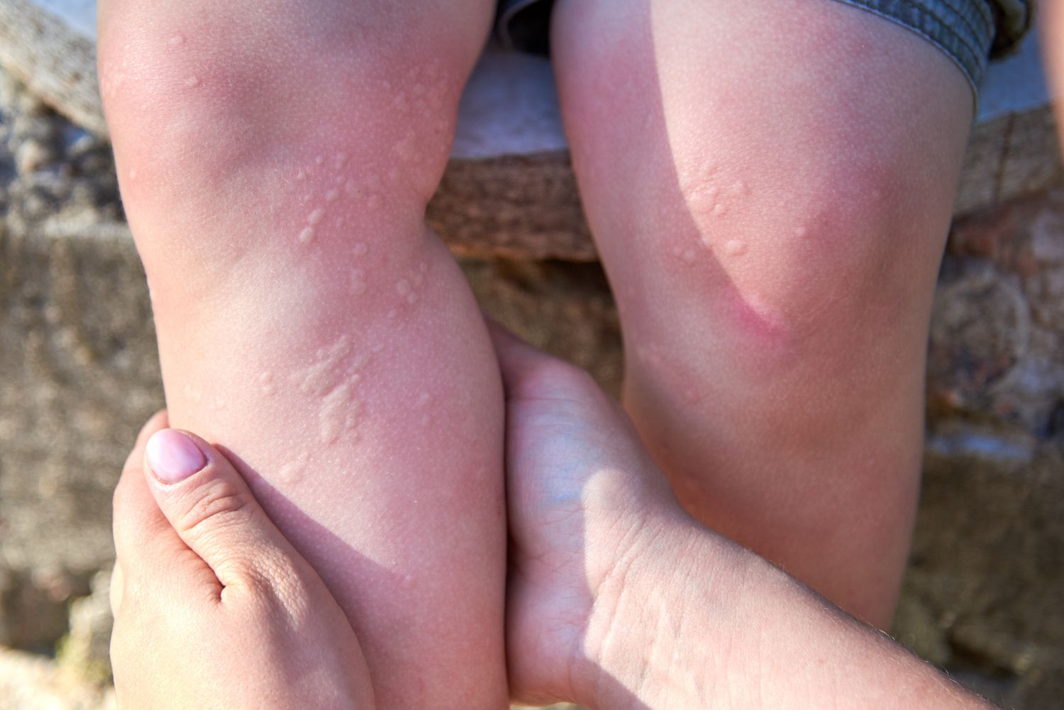 nettle sting