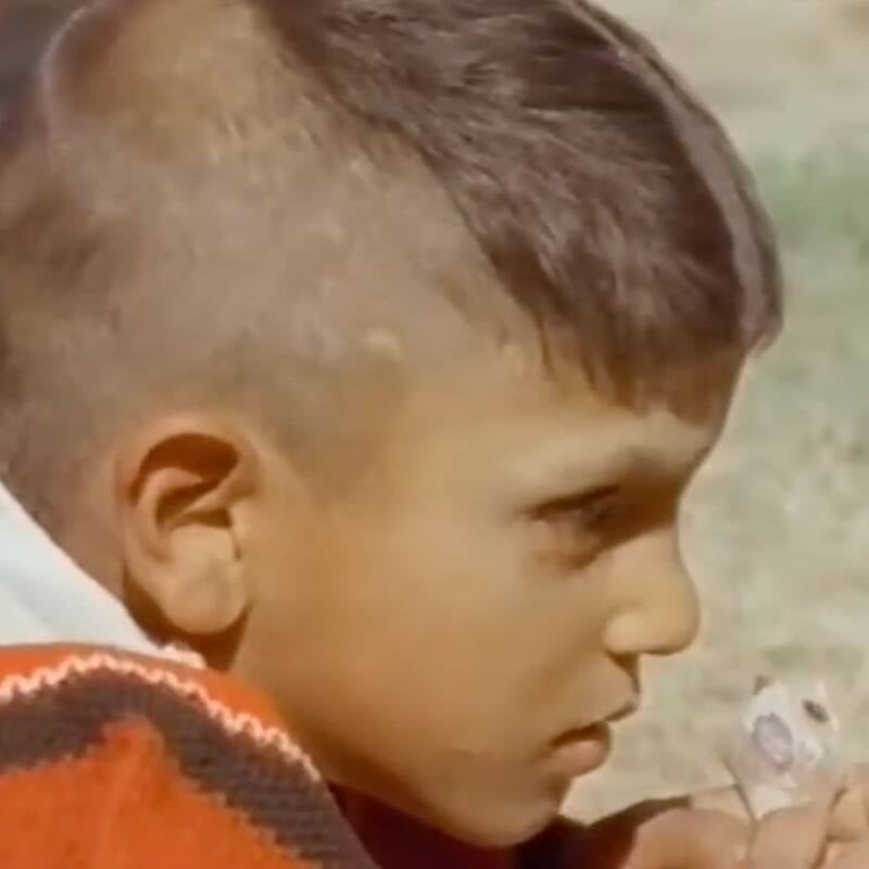 Titu Singh Head Birthmark