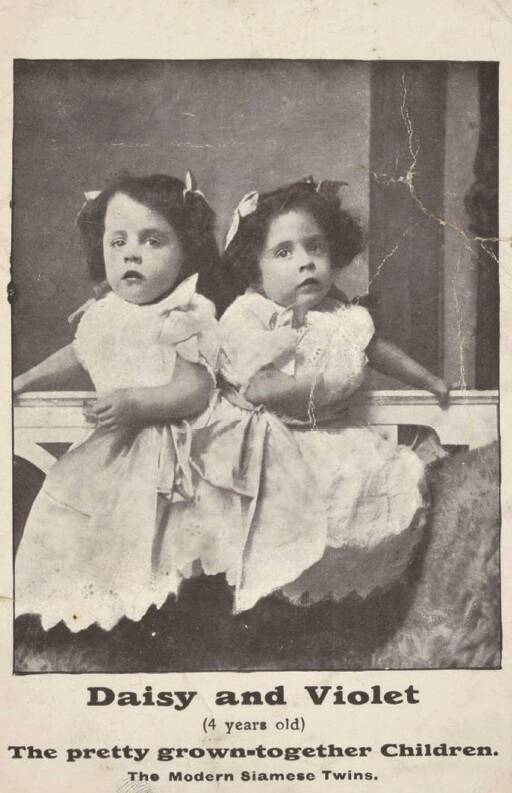 Daisy And Violet Hilton At Age Four